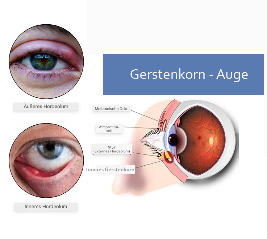 Gerstenkorn - Inneres Gerstenkorn